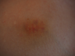 bruise